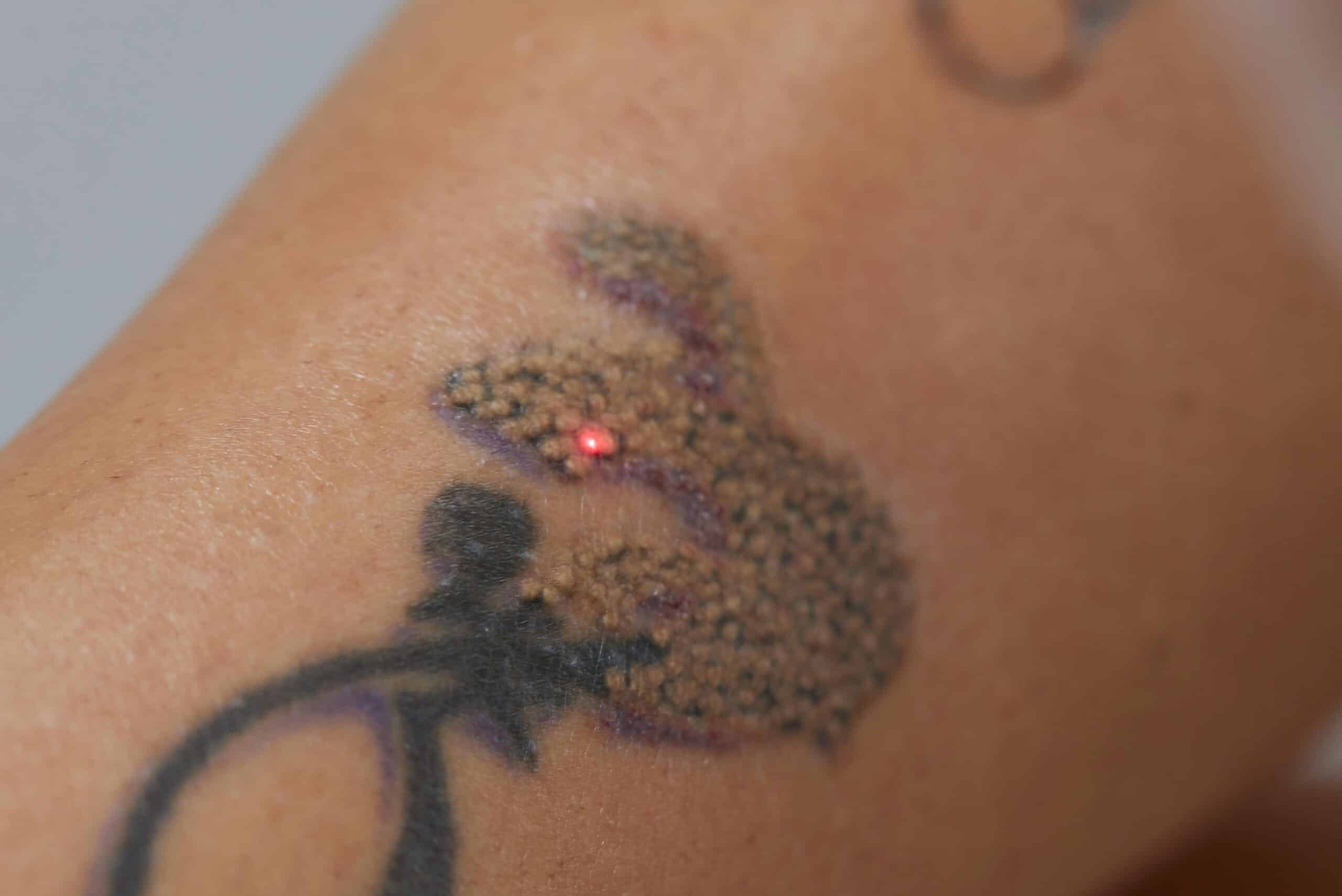Peut-on se faire détatouer quand on a la peau mate ?