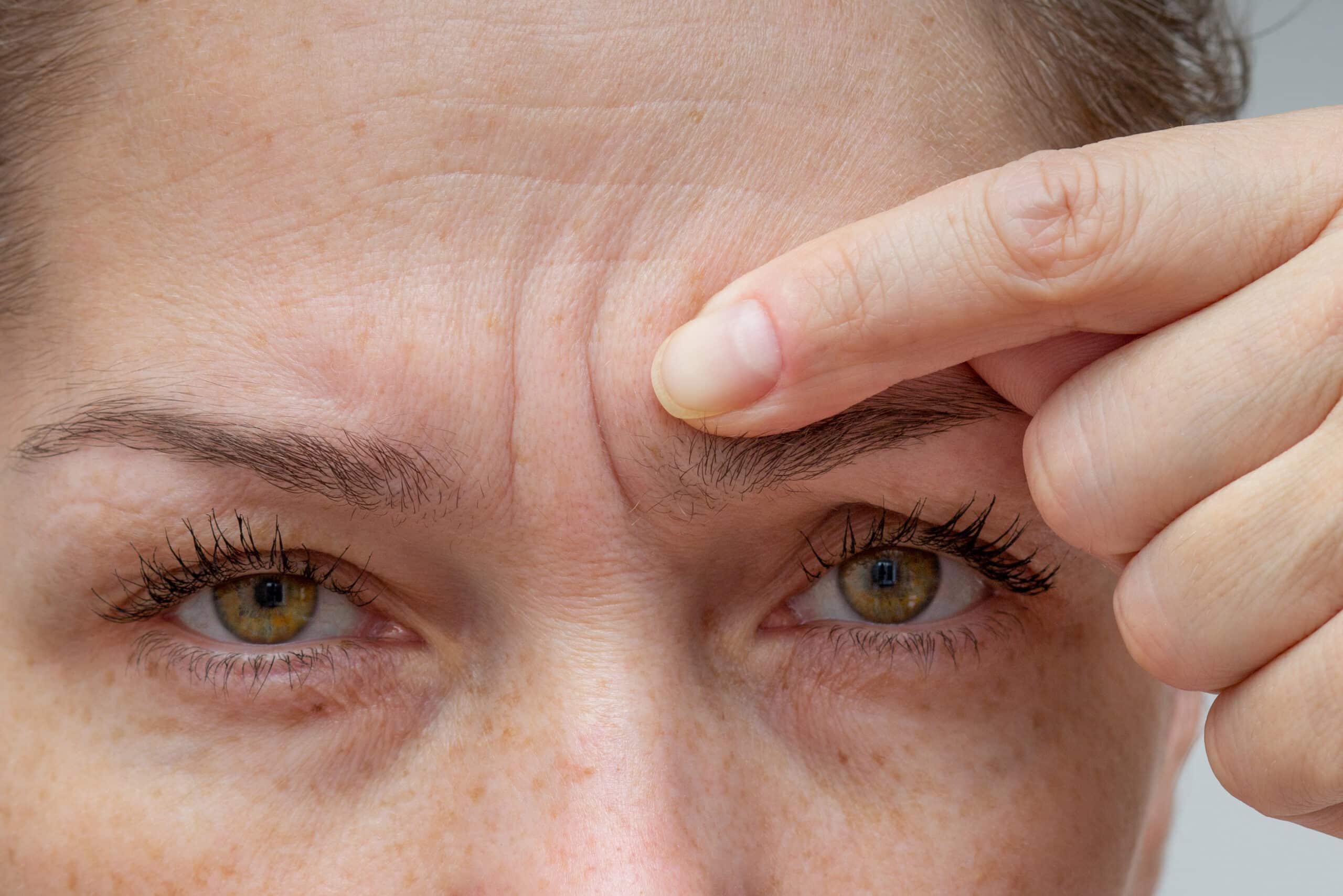 Botox ou acide hyaluronique